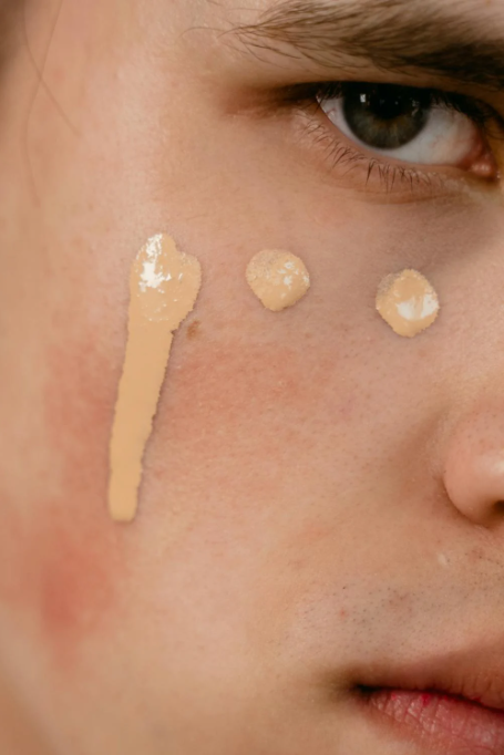 Técnica de camuflaje terapéutico: aplicación de corrector con óxidos de hierro para neutralizar manchas de melasma.