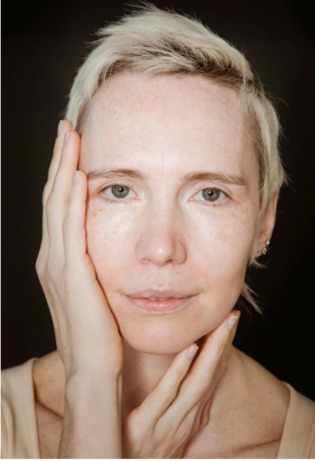 Melasma en el labio superior: ejemplo de mancha hormonal común causada por estrógenos o anticonceptivos.